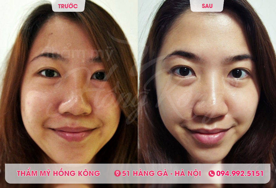 Khách hàng trước và sau khi tẩy da chết, chăm sóc da tại Thẩm mỹ Hồng Kông