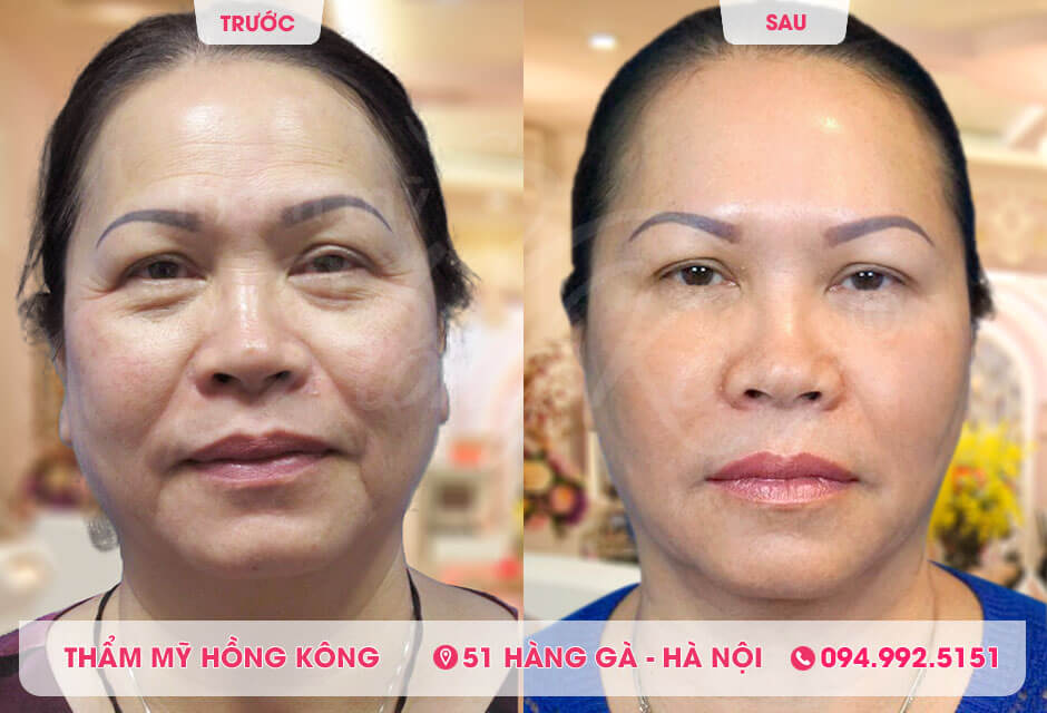 Khách hàng trước và sau khi căng da vùng mắt tại Thẩm mỹ Hồng Kông