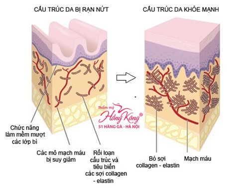 Năng lượng sóng RF kích thích tái tạo và tăng sinh collagen