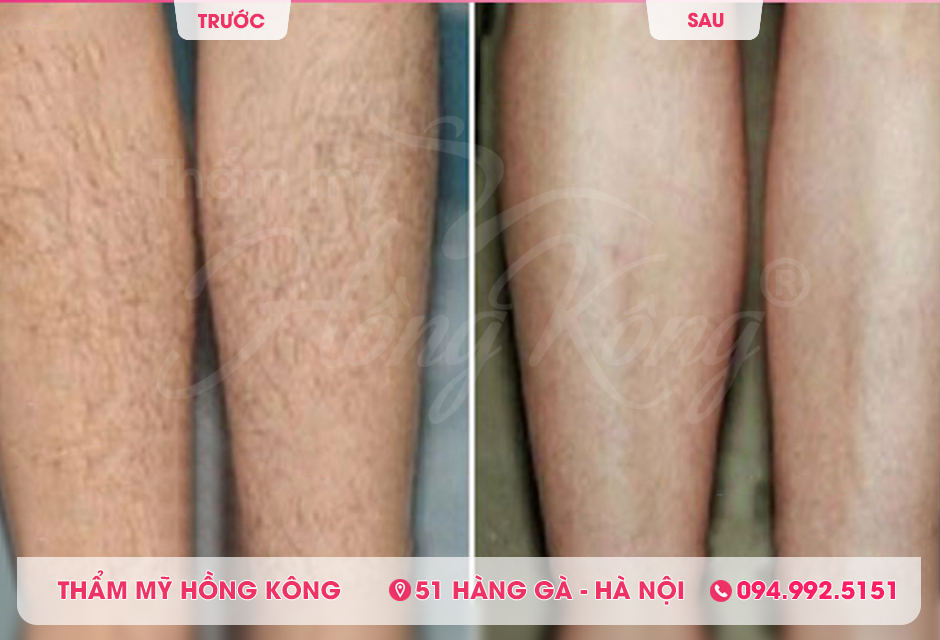 Khách hàng trước và sau khi triệt lông bằng The Record 618 tại Thẩm mỹ Hồng Kông