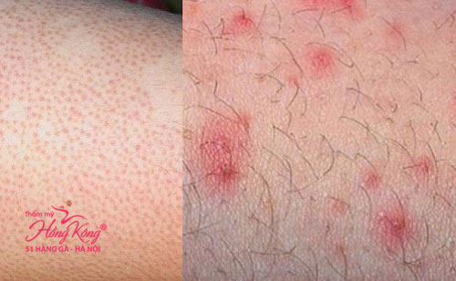 Tẩy lông sai cách gây viêm nhiễm, tổn thương da