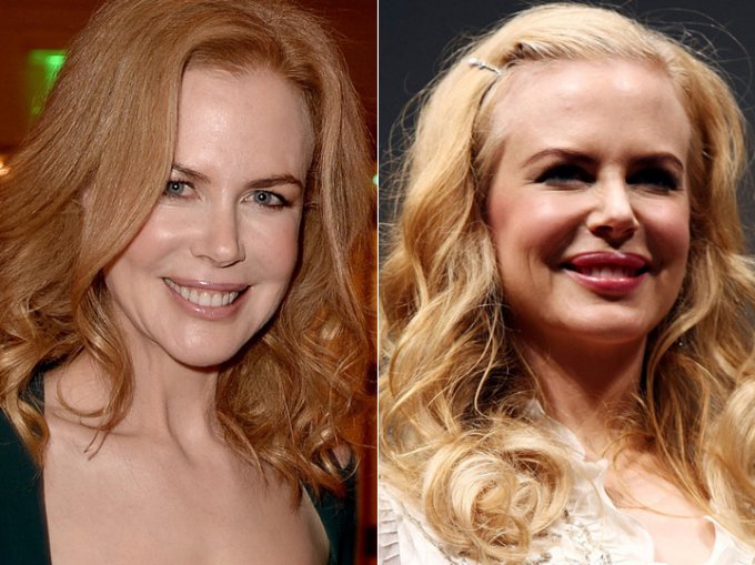 Ngôi sao Nicole Kidman vói khuôn mặt cứng đờ như sáp do tiêm botox quá đà