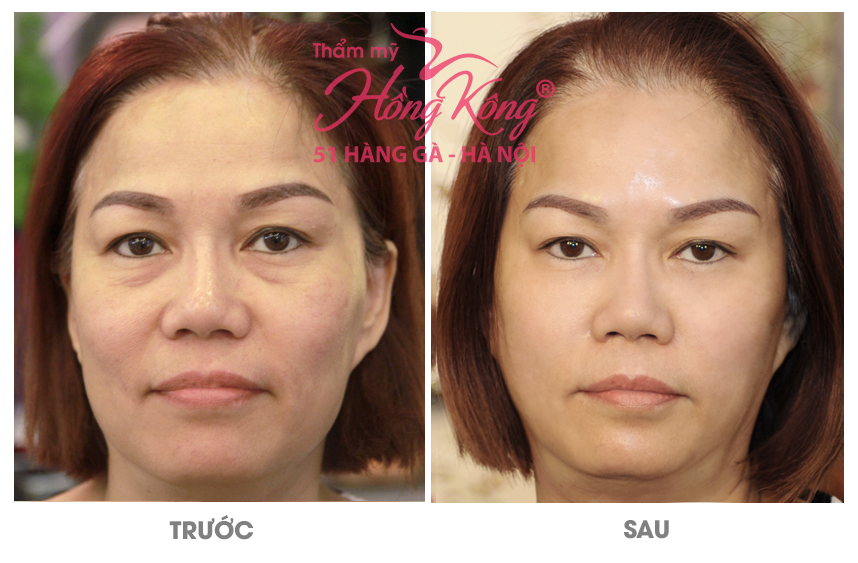 Kết quả của khách hàng trước và sau khi thực hiện trẻ hóa da tại thẩm mỹ Hồng Kông, 51 Hàng Gà