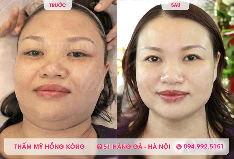 Hình ảnh khách hàng trước và sau khi sử dụng công nghệ căng da mặt bằng Ultherapy
