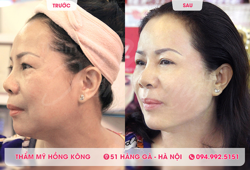 Hình ảnh khách hàng trước và sau khi sử dụng công nghệ Ultherapy tại Thẩm mỹ Hồng Kông 51 Hàng Gà