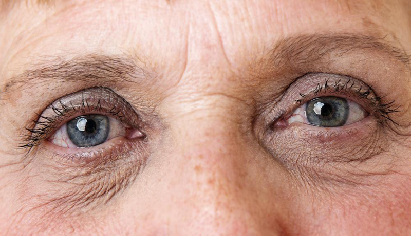 Các nếp nhăn quanh mắt là dấu hiệu dễ nhận biết nhất của lão hóa da