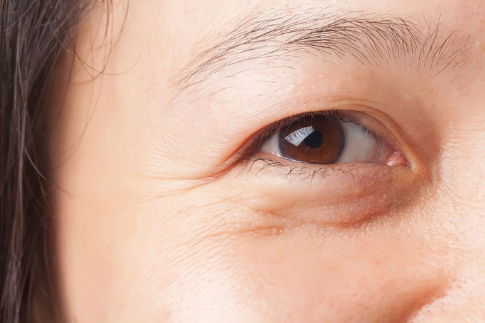 Công nghệ xóa nhăn khóe mắt có thực sự hiệu quả như quảng cáo?