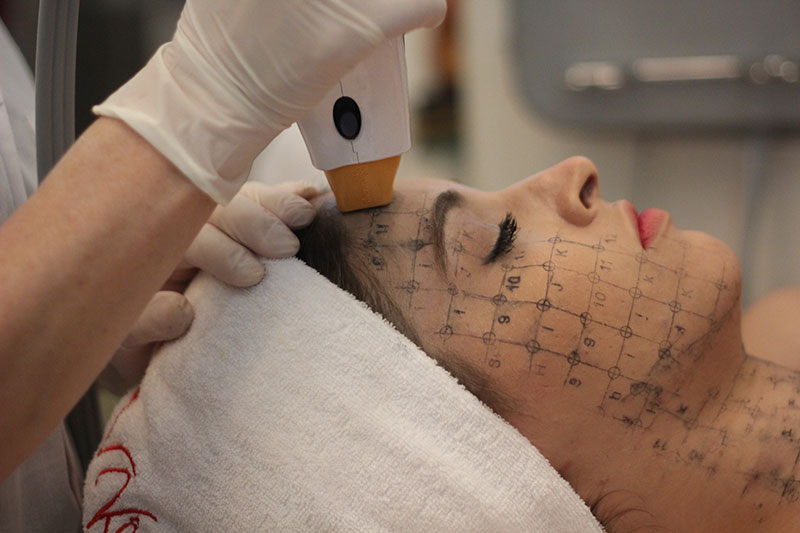 Căng da mặt bằng công nghệ Thermage có đau không là câu hỏi của nhiều khách hàng