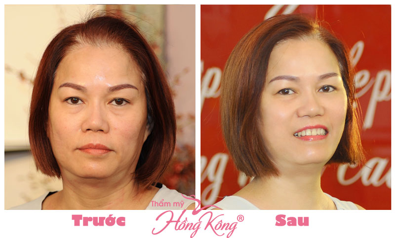 Khách hàng trước và sau khi thực hiện căng da mặt tại Thẩm mỹ Hồng Kông