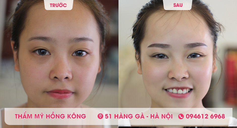 Khách hàng trước và sau khi phun lông mày tại Thẩm mỹ Hồng Kông