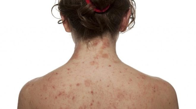 Mụn ở lưng nếu không được điều trị kịp thời sẽ gây tổn thương cho làn da