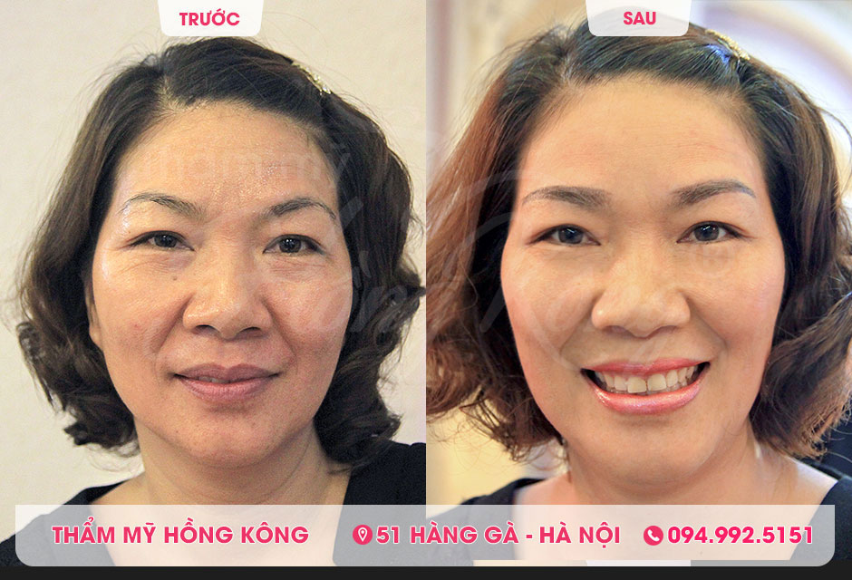 Hình ảnh thực tế của khách hàng trước và sau khi căng da bằng Ultherapy