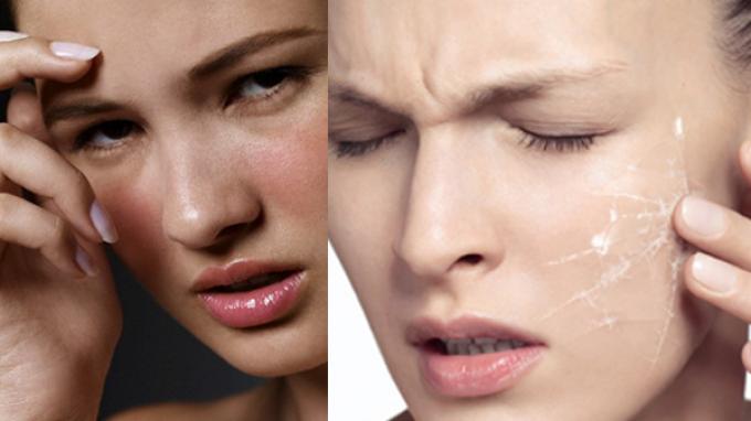 Căng da mặt bằng công nghệ Ultherapy có nguy hiểm không là thắc mắc của rất nhiều người